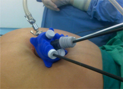 Single Incision Laparoscopic Appendicectomy