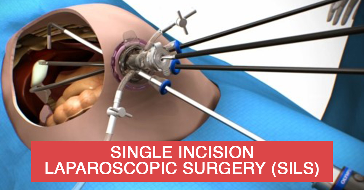 Single Incision Laparoscopic Surgeon in Mumbai
