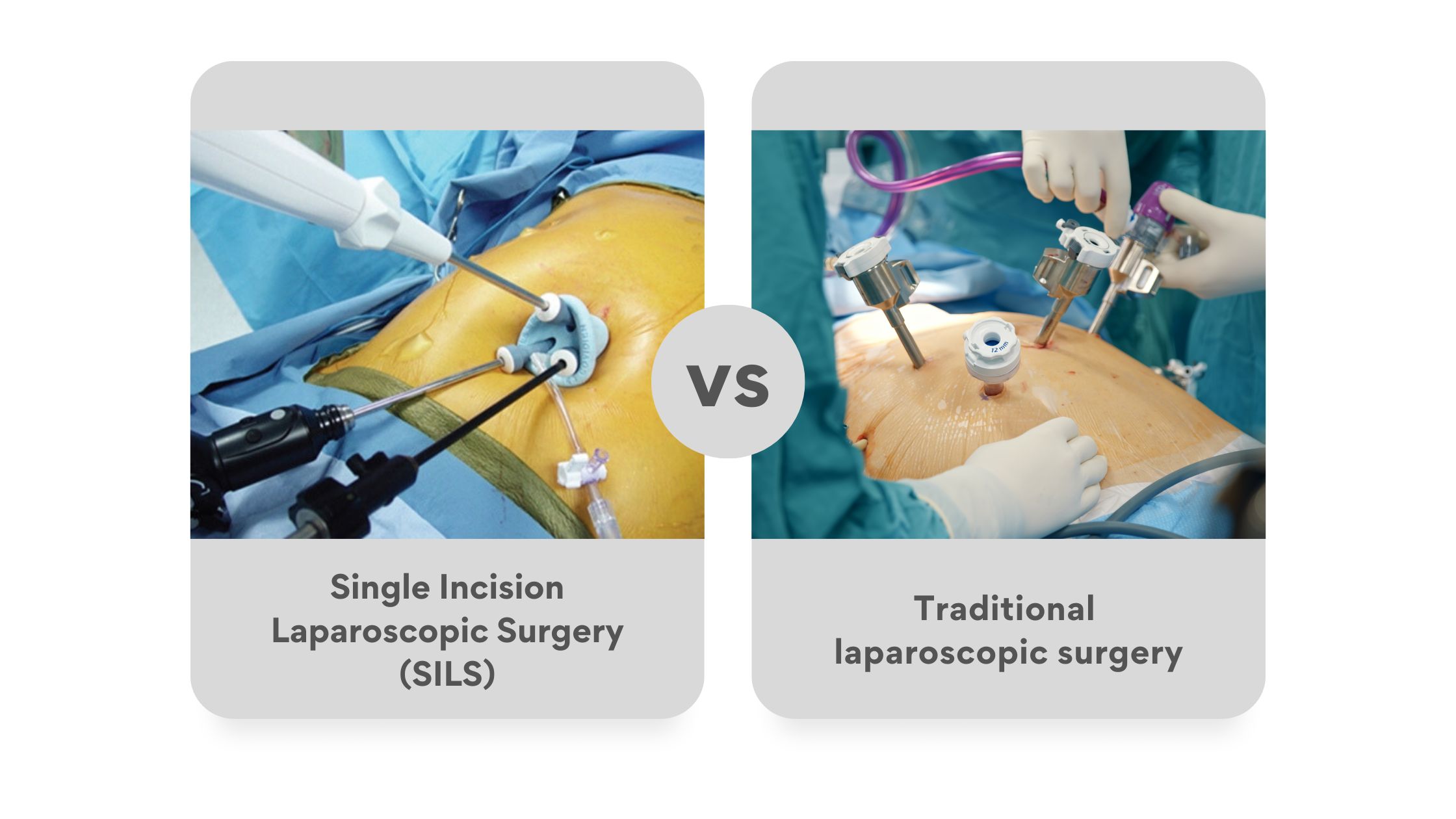 Differences between Single Incision Laparoscopic Surgery (SILS) and traditional laparoscopic surgery