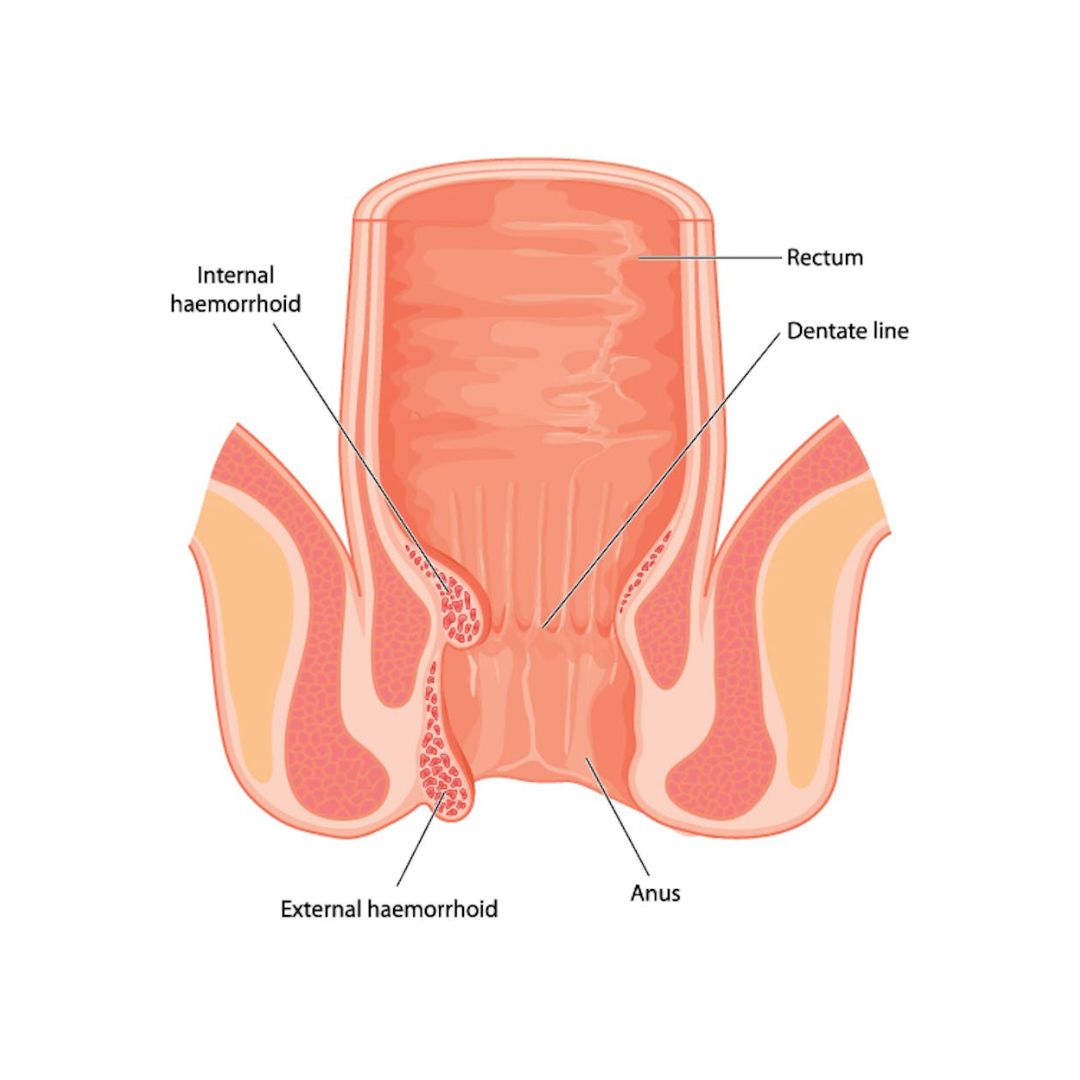 Haemorrhoids (Piles)