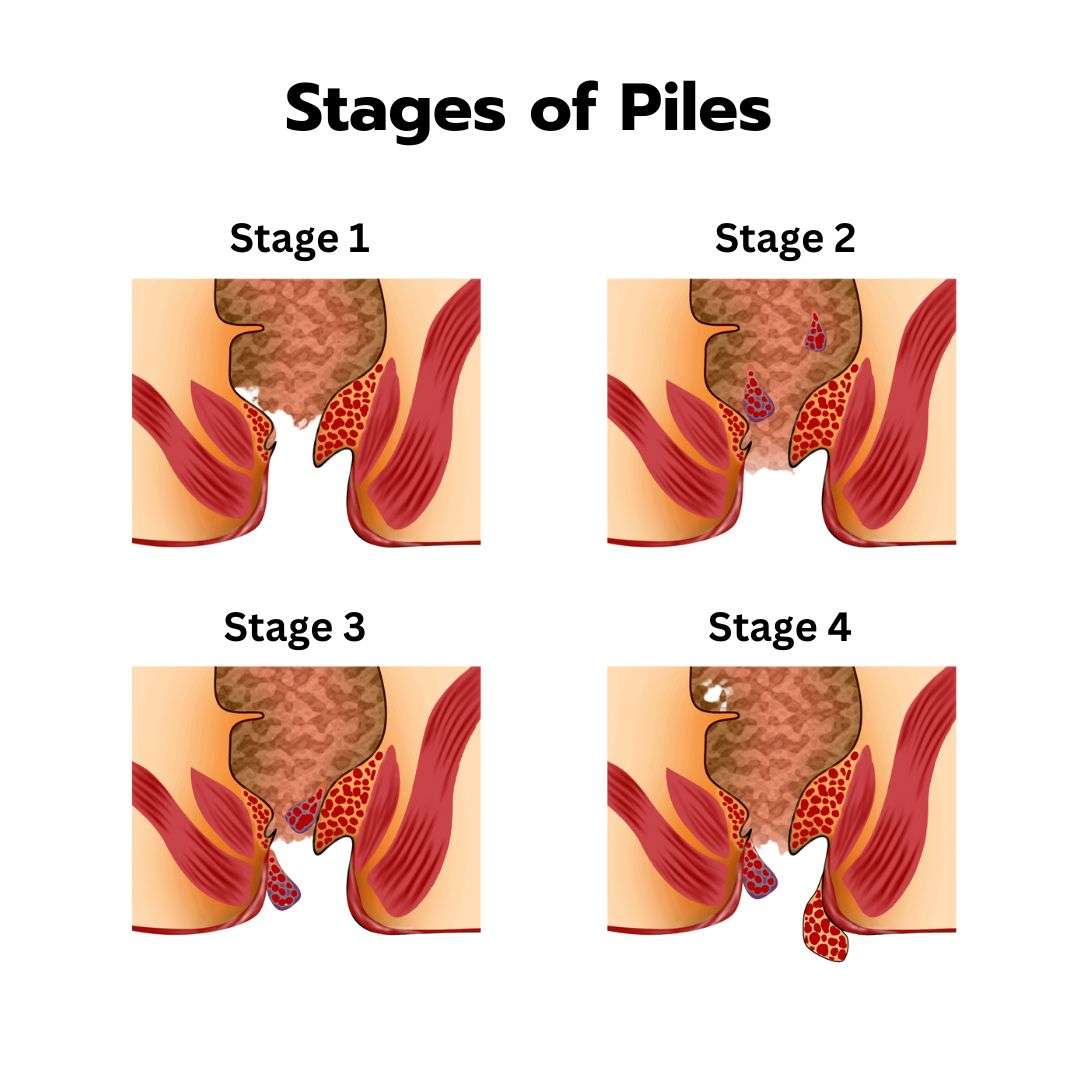 Stages of Piles