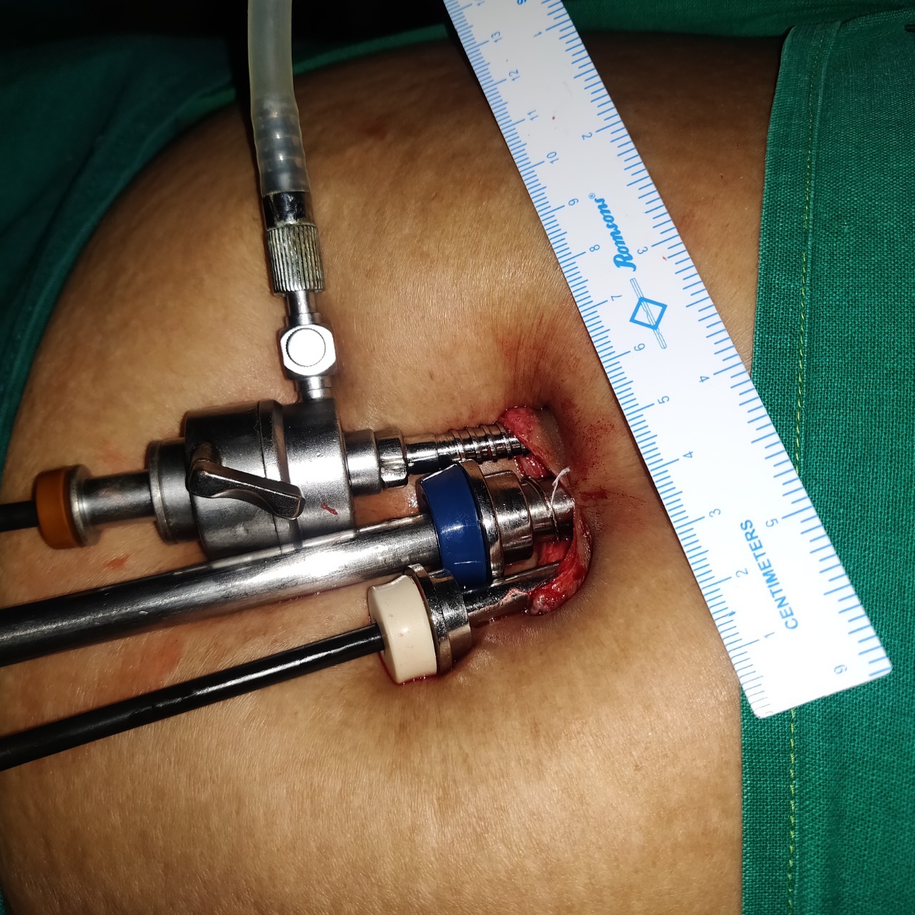 Single Incision Laparoscopic Surgery (SILS)